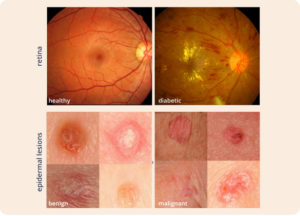 Fundus Photograph - Skin Cancer Images