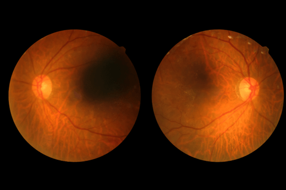 Diabetic Retinopathy Prevalence at an All-Time High According to Recent Study