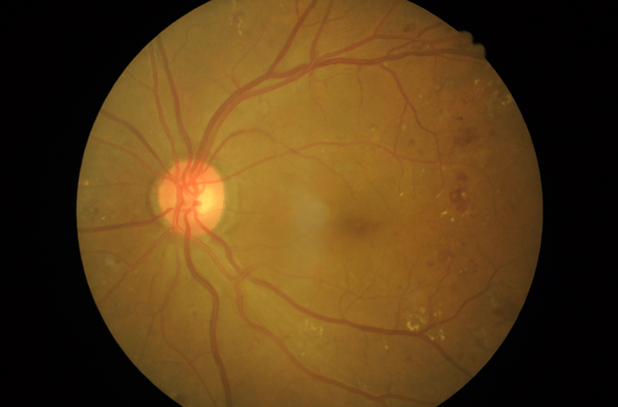 Treating Diabetic Retinopathy